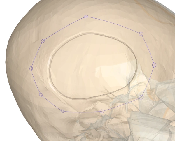 The top of a skull with a hole in it, and a user selection around the hole.