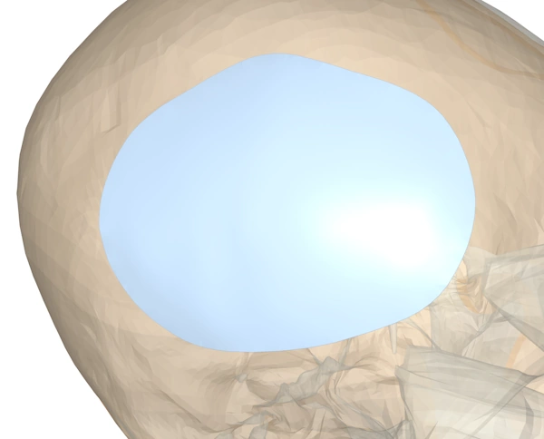 A custom-printed cranial plate covering a large hole in the top of a skull.