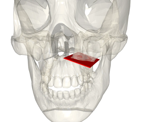 The image shows a transparent skull model with a cuboid cutting tool mimicking the cut performed by a surgeon to allow for realignment.