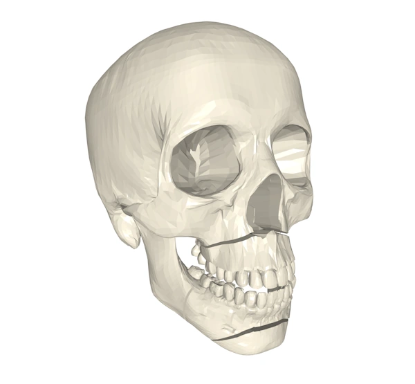 A skull model after a surgeon has made cuts and realigned the jaw.