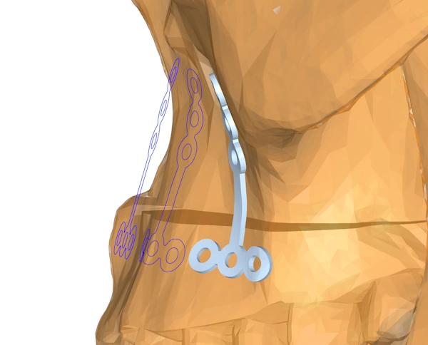 A 2D planar slice through a strip implant placed above the skull model, and also wrapped onto the skull model using a uv wrapping.