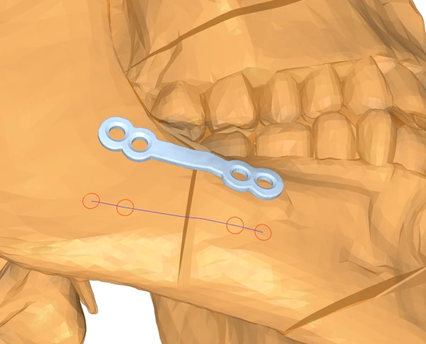 The surgeon selects anchor points for the strip plate implant on either side of the cut.