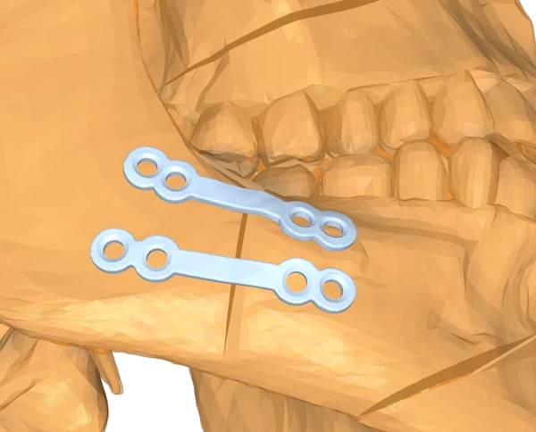 A strip implant is create in-place by offsetting and thickening the sheet surface of the shrinkwrap.
