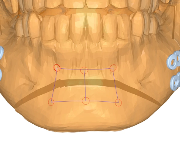 In this image the surgeon has selected a more complex strip plate layout on the lower jaw.