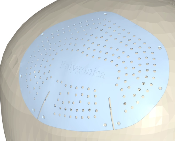 A complete skull cap implant model, with flexibility slots, breathing holes, embossed labels and fixing holes.