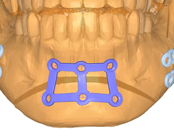 The complex strip plate has been created to anchor the lower jaw.