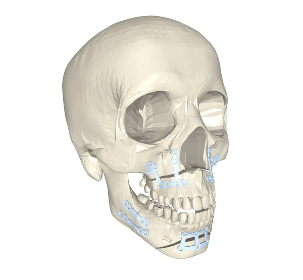An image of a skull in which the jaw bones have been cut and realigned, held in place by 3D printed strip implants.