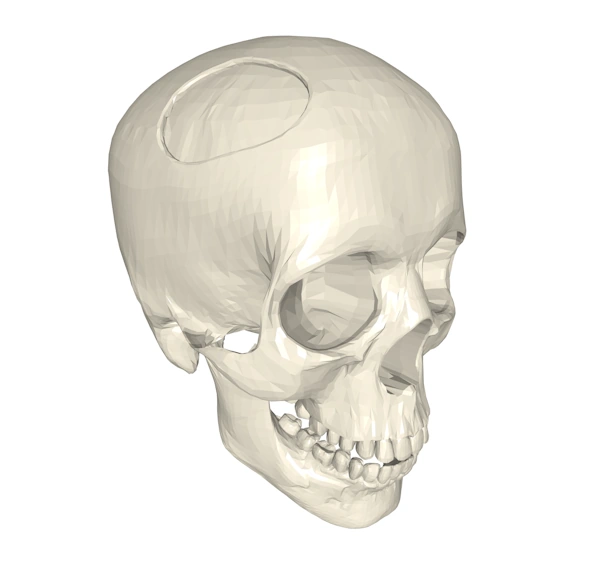 A skull model with a large hole in the upper left cranium.