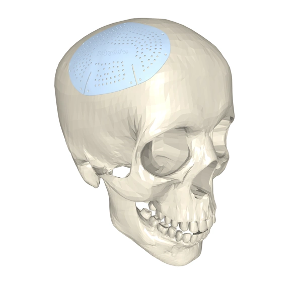 A skull model in which a large hole in the cranium has been closed by a custom 3D-printed implant.