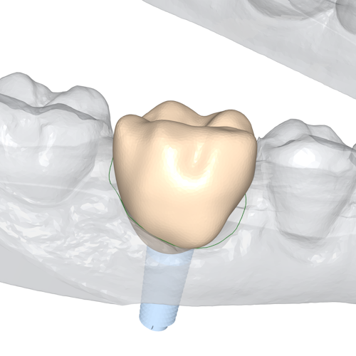 A crown implant shown in-situ in the lower jaw. There is a big gap between the crown and the existing gum.
