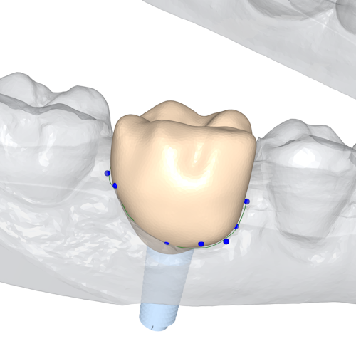 Using guide points the crown is morphed so it fills more of the existing hole.