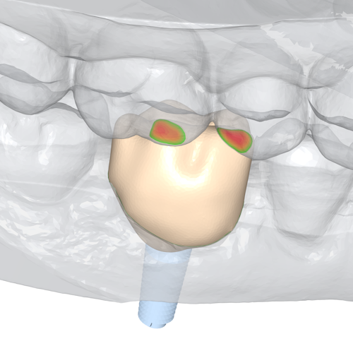 An difference map is computed compared with the lower jaw to determine occlusion.