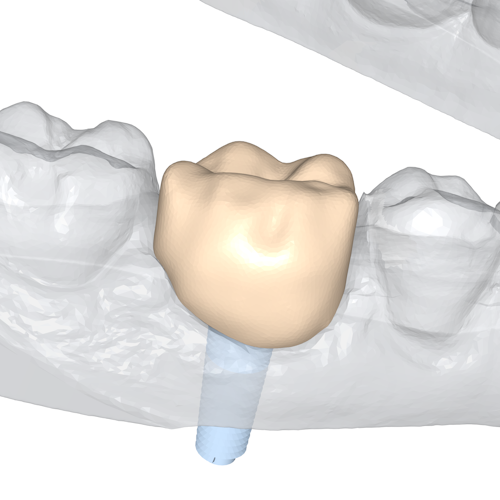 The final crown, after occlusion adjustment and clipping to the lower jaw.