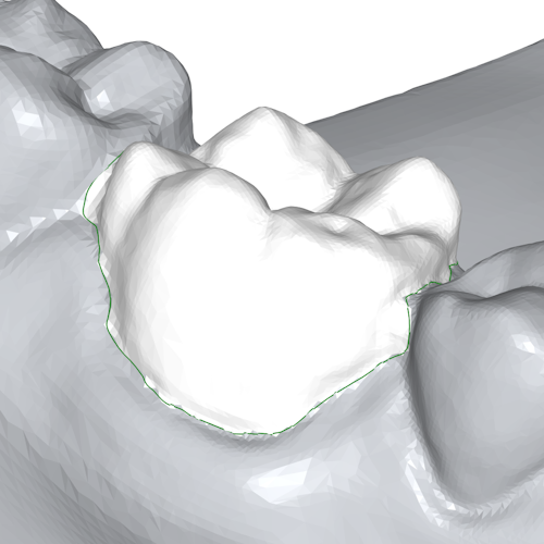 The image shows a highlighted tooth within a lower jaw.