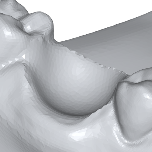 The highlighted tooth has been removed and a temporary surface added to keep the model watertight