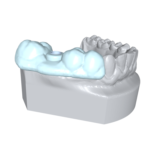 A lower jaw model with an implant guide covering a portion