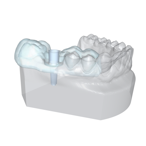 A transparent lower jaw model with a transparent implant guide covering a portion. The implant, created with Polygonica, is visible inside the jaw.