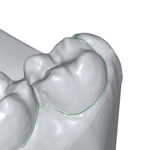 The margin line has now been corrected around the tooth.