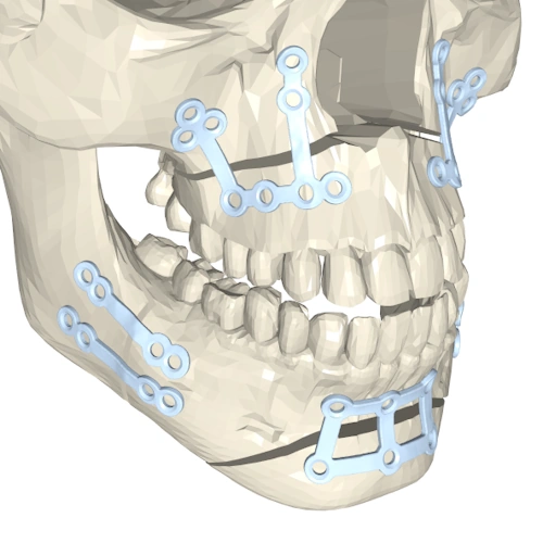 Orthognathic and cranial surgery planning blog image